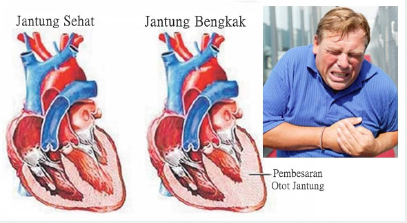 Ciri Ciri Gejala Penyakit Jantung Bengkak | Obat Jantung  